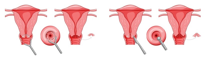 Set of Cervical Dysplasia Female reproductive system uterus cancer carcinoma in different styles and cross sections. Front view in a cut. Human anatomy internal organs location scheme flat style icon