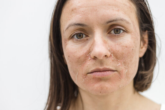 Cropped photo of woman with dry skin over white background.
