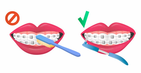 Vector isolated image of instructions to rule of right and false brush teeth with dental braces, retainer. Concept tooth care, braces and chosen toothbrush. You can used in web design, postcard, etc