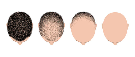 Hair loss bald head alopecia transplant growth vector top view. Hair loss men top view alopecia scalp problem - obrazy, fototapety, plakaty