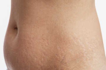Stretch marks on a woman's abdomen. Consequences of childbirth and weight gain. Close-up. White...
