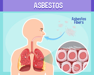 Obraz premium Diagram showing asbestosis in lungs