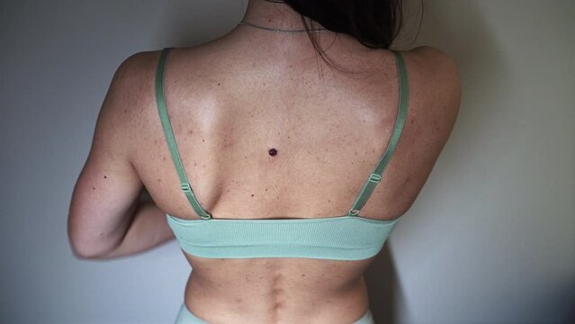 Problematic Skin - back of a young woman with multiple small birthmarks and bumps on the skin with one large seborrheic keratosis