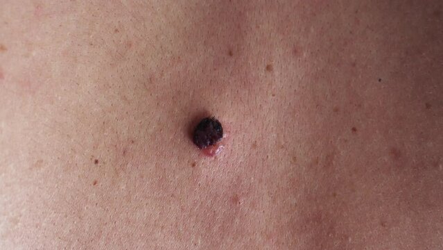 Examining seborrheic keratosis after Cryotherapy on the back skin. Macro.