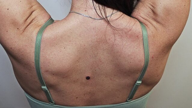 Problematic Skin - inspecting women's back. Close Up