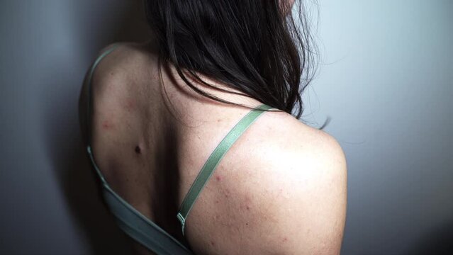 Problematic Skin - back of a young woman with multiple small birthmarks and bumps on the skin with one large seborrheic keratosis