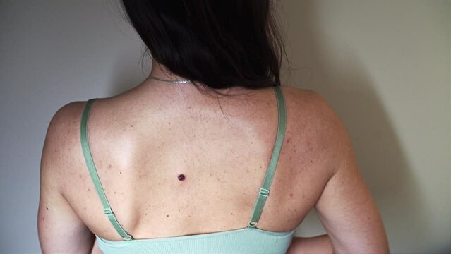 Positive thinking young woman's back with multiple small birthmarks and bumps on the skin with one large seborrheic keratosis - dancing.