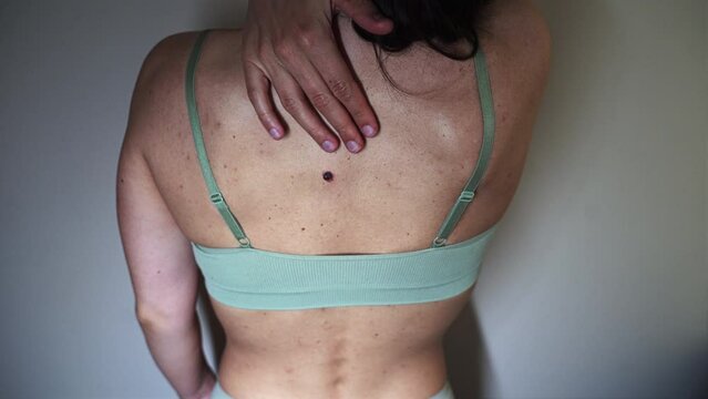 The woman's back is covered in acne and pimples. Skin problems. Dermatology.