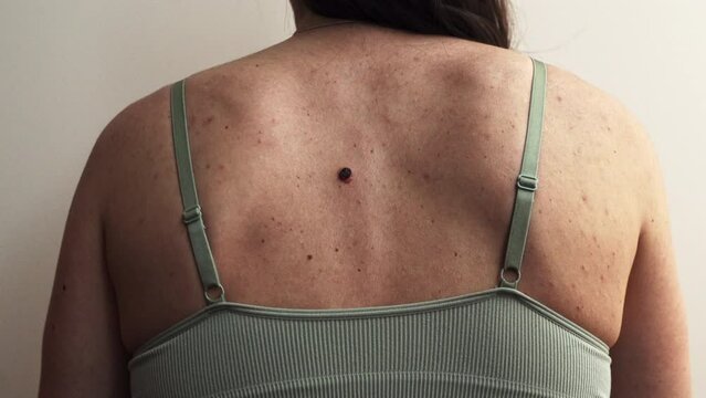 Problematic Skin - back of a young woman with multiple small birthmarks and bumps on the skin with one large seborrheic keratosis