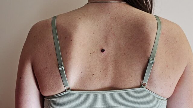 Problematic Skin - back of a young woman with multiple small birthmarks and bumps on the skin with one large seborrheic keratosis