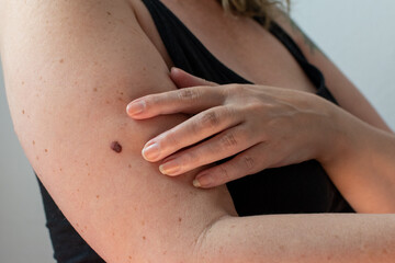 woman checking her skin for an abnormal mole for signs of melanoma skin cancer - obrazy, fototapety, plakaty