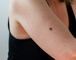 an example of a malignant melanoma skin cancer mole on a woman's arm