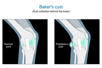 Baker's cyst. knee joint - obrazy, fototapety, plakaty