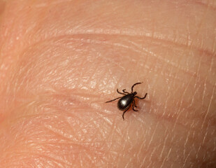 Infectious Encephalitis Ixodes Scapularis or Persulcatus Deer Tick Insect on Skin. Encephalitis...