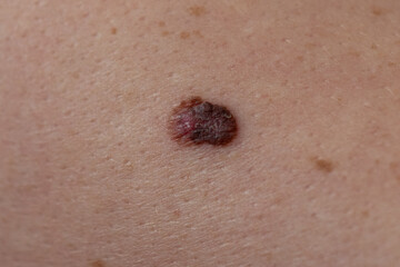 extreme close up of a large mole that was diagnosed as malignant melanoma skin cancer - obrazy, fototapety, plakaty