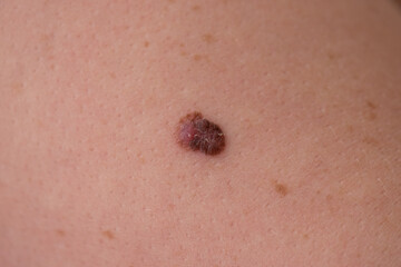 close up of an atypical mole with two colours which was diagnosed as malignant melanoma skin cancer skin cancer  - obrazy, fototapety, plakaty