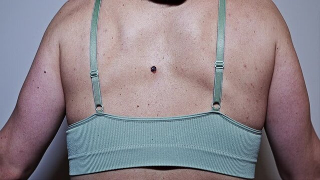 The woman does not know what to do. Back of a young woman with multiple small birthmarks and bumps on the skin with one large seborrheic keratosis