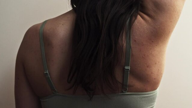 Young woman with dark hair showing back. Potential Skin problems.