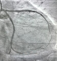 Normal left coronary artery (LCA) angiogram.