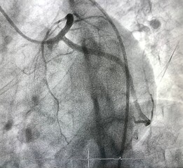 Normal left coronary artery (LCA) angiogram.