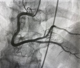 Normal right coronary artery (RCA) angiogram.