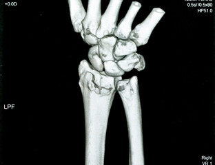 CT scan right wrist joint 3D view shows right distal radius fracture for closed reduction and cast, selective focus of a CAT scan imaging showing fracture radius bone after direct trauma to the wrist - obrazy, fototapety, plakaty
