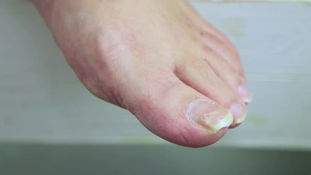Large nail on the index finger of a male foot. The concept of male pedicure and foot care. Isolated video, copy space, close-up. UHD 4K.