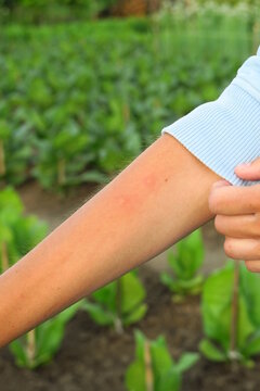 female farmer shows insect bites while working on the farm. problem with mosquitoes on plantations concept