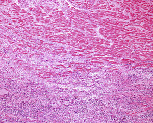 Human heart myocardium. Ischemic infarct