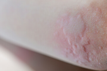 Urticaria on the skin. Red spots of an allergic reaction on the skin of a child. Urticaria symptoms...