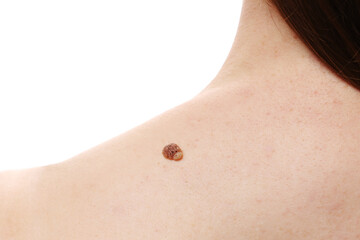 large nevus wart on young female shoulder, woman visiting doctor dermatologist, concept of benign...
