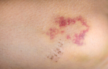 Bruises on the human body. Severe bruise from impact, bruising and hematoma.