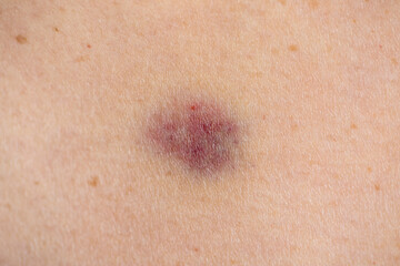 Bruises on the human body. Severe bruise from impact, bruising and hematoma.