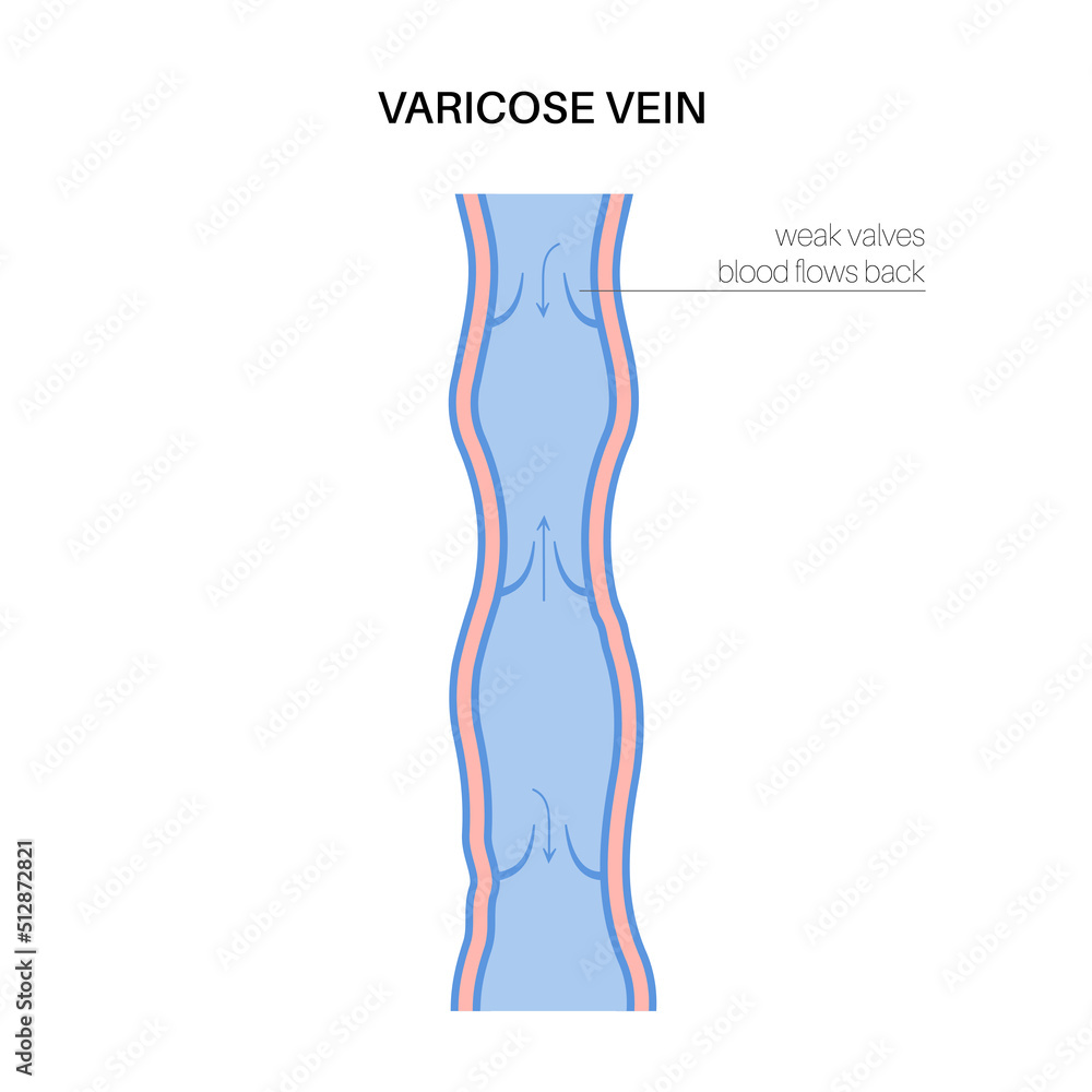 Wall mural Varicose veins treatment