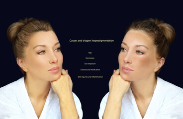 Hyperpigmentation: chloasma, melasma , age spots,Post-inflammatory hyperpigmentation.Hyperpigmentation removal