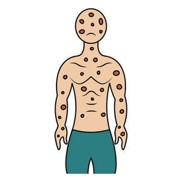 Smallpox on the human body. Color vector illustration. The face and body of the patient is covered with spots. Muscular man is sad. Isolated background. Cartoon style. Medical theme. 