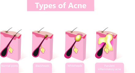Types of acne pimples. Healthy skin, Whiteheads and Blackheads, Papules and Pustules.
