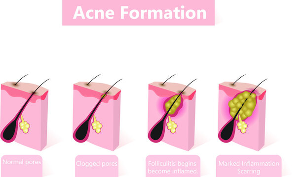 Formation of skin acne or pimple. The sebum in the clogged pore promotes the growth of a certain bacteria. This leads to the redness and inflammation associated with pimples.