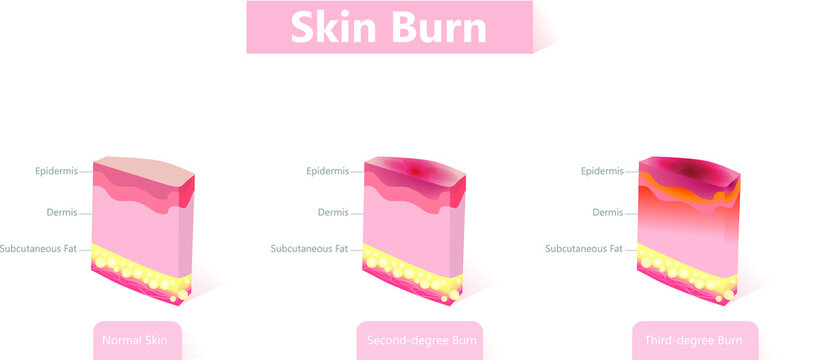 skin burn. Three degrees of burns. 