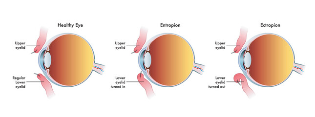 Medical illustration shows the comparison between a normal eye, one affected by entropion and another affected by ectropion.