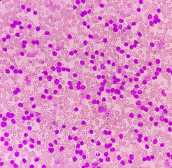Acute leukemia, peripheral blood smear show most of cell are blast cell with abundant cytoplasm,...