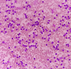 Acute leukemia, peripheral blood smear show most of cell are blast cell with abundant cytoplasm, variable chromatin present.