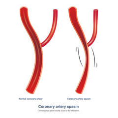 Coronary artery spasm is the pathogenesis of variant angina pectoris. Spasm usually occurs at the bifurcation of coronary artery.