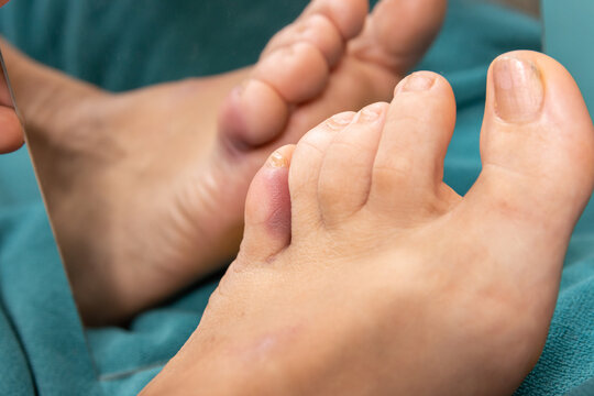 Broken and bruised little toe from blood spill