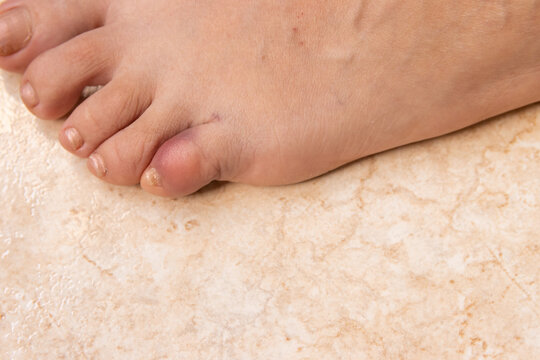 Broken and bruised little toe from blood spill