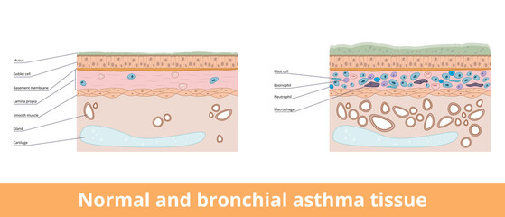Normal and bronchial asthma tissue. Visualization of difference between normal and bronchial asthma tissues, including goblet cells and smooth muscle, lamina propia and mast cells. - obrazy, fototapety, plakaty