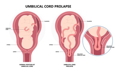 fatal cord with labor delivery of the fetus baby birth twins fluid breech and c section overt funic occult vasa previa obstetrical water breaking transverse lie