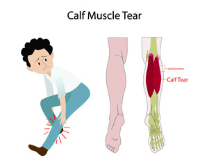 illustration of biology and medical, calf tear and Torn Calf Muscle, A torn calf muscle is an injury that causes a partial or complete tear in the muscles behind shin bone