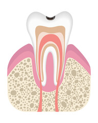 Stage of caries development. Tooth structure in flat style. Tooth decay with enamel. Dental disease realistic vector illustration