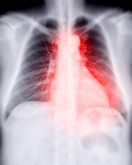 Chest x-ray image for diagnosis TB,tuberculosis and covid-19.